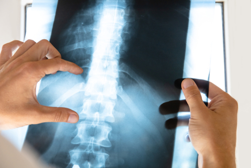 Did You Suffer A Spinal Injury From A Car Accident? Here’s What You Need to Know